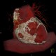 Constrictive pericarditis, VRT: CT - Computed tomography
